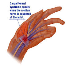 Carpal Tunnel-Hand